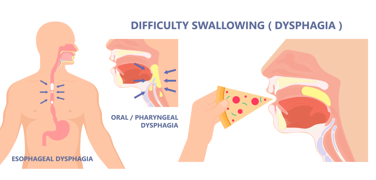 DIFFICULTY IN SWALLOWING (DYSPHAGIA)